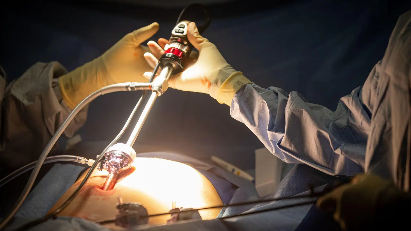 success-rate-of-laparoscopic-appendectomy